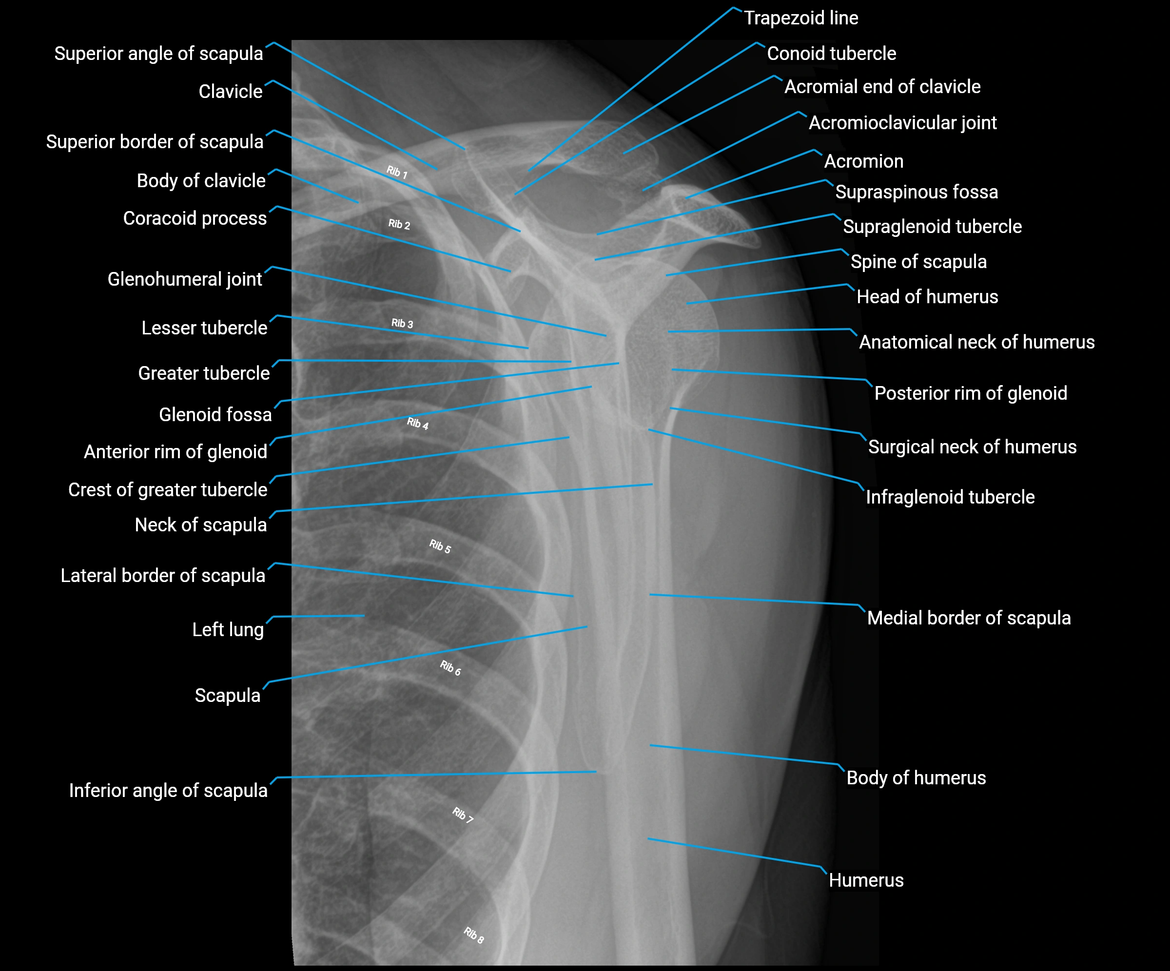 X Ray shoulder lateral anatomy labelled image.webp
